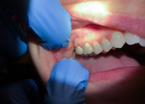 Best Urgent Tooth Repair  in Valley City, ND